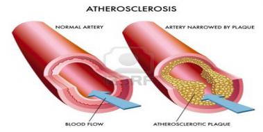 Aterosklerotik Kalp Hastal