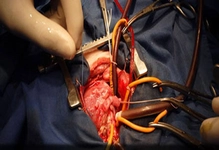 Kalp Anjiyosu Nasıl Yapılır?