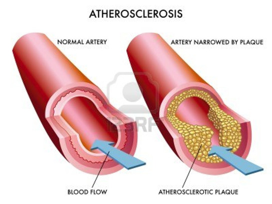 Aterosklerotik Kalp Hastalığı