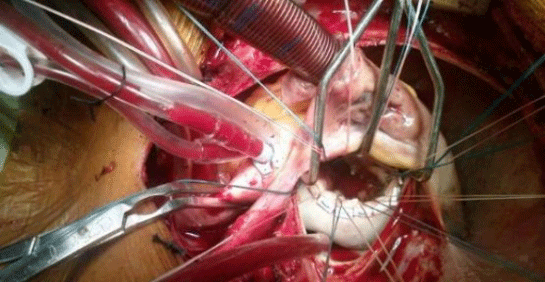 Kalp Kapakçığı Ameliyatı