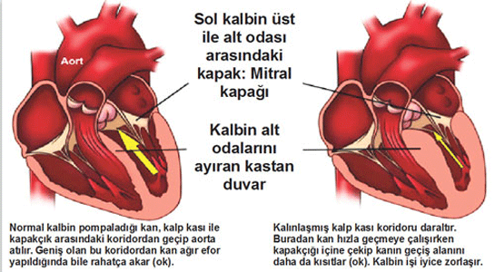 Kalp Kapaknda kme